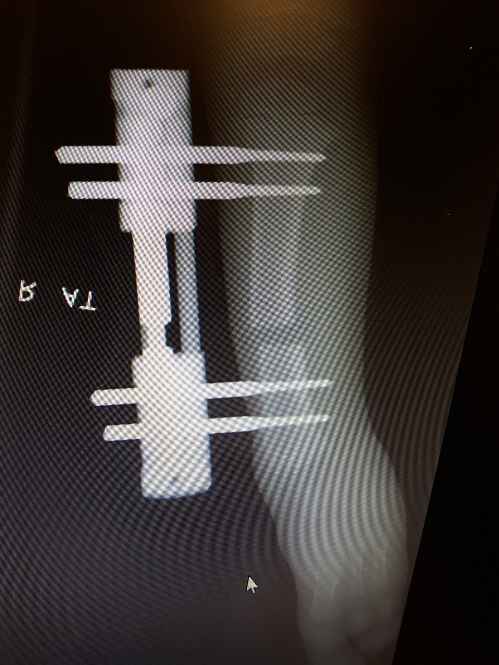 Tibia Uzatma